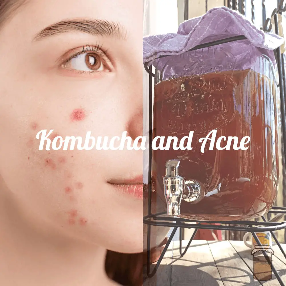 Relationship between kombucha and acne