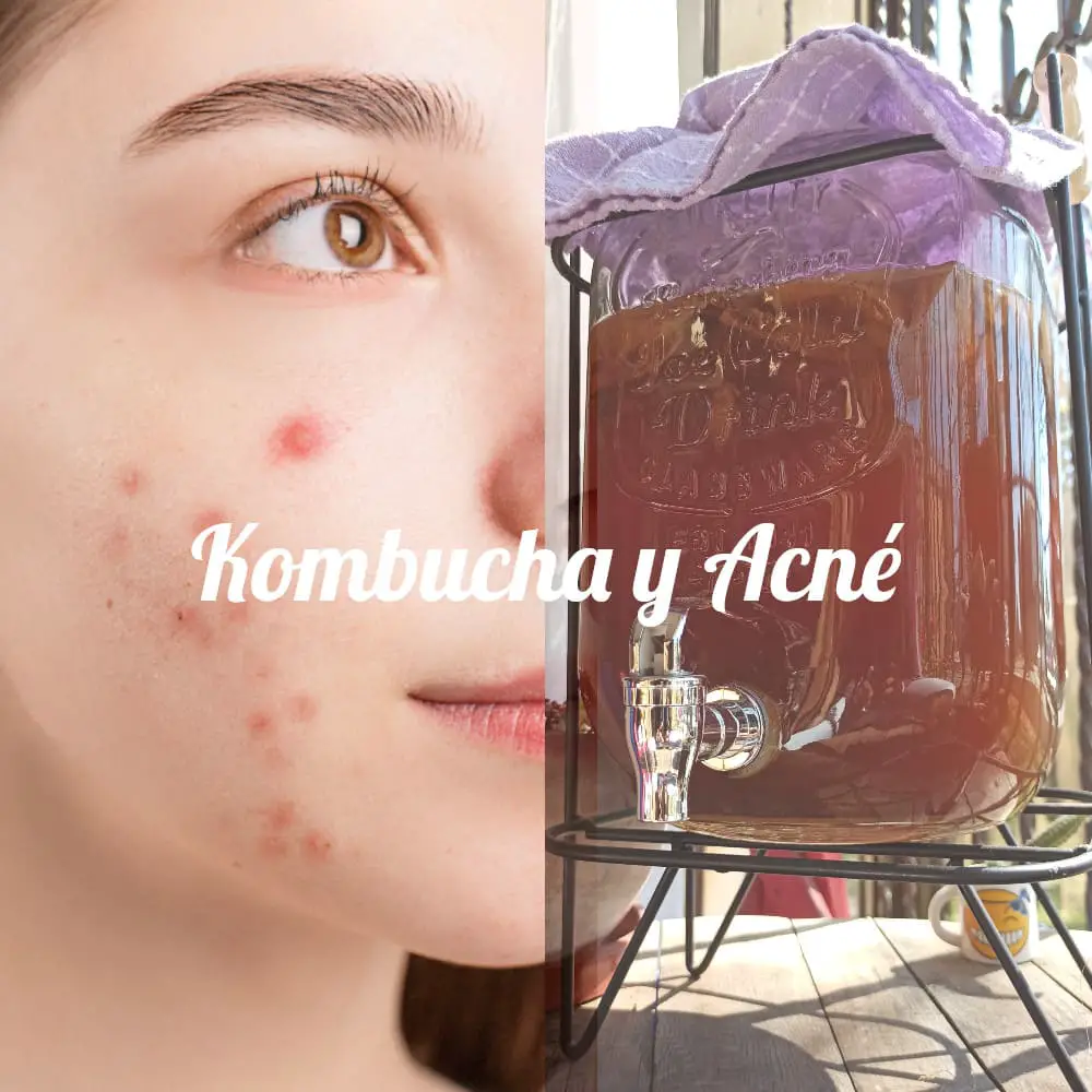 Puede la kombucha causar acné