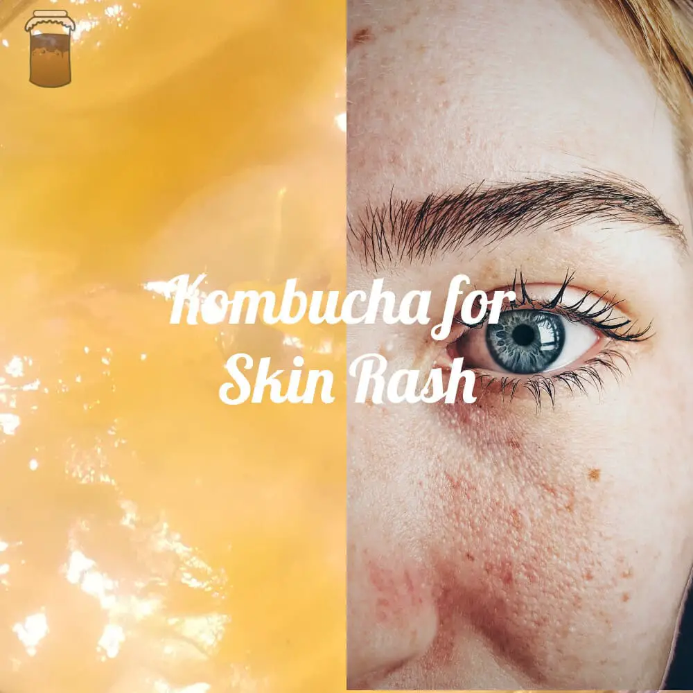 Kombucha on Skin rash